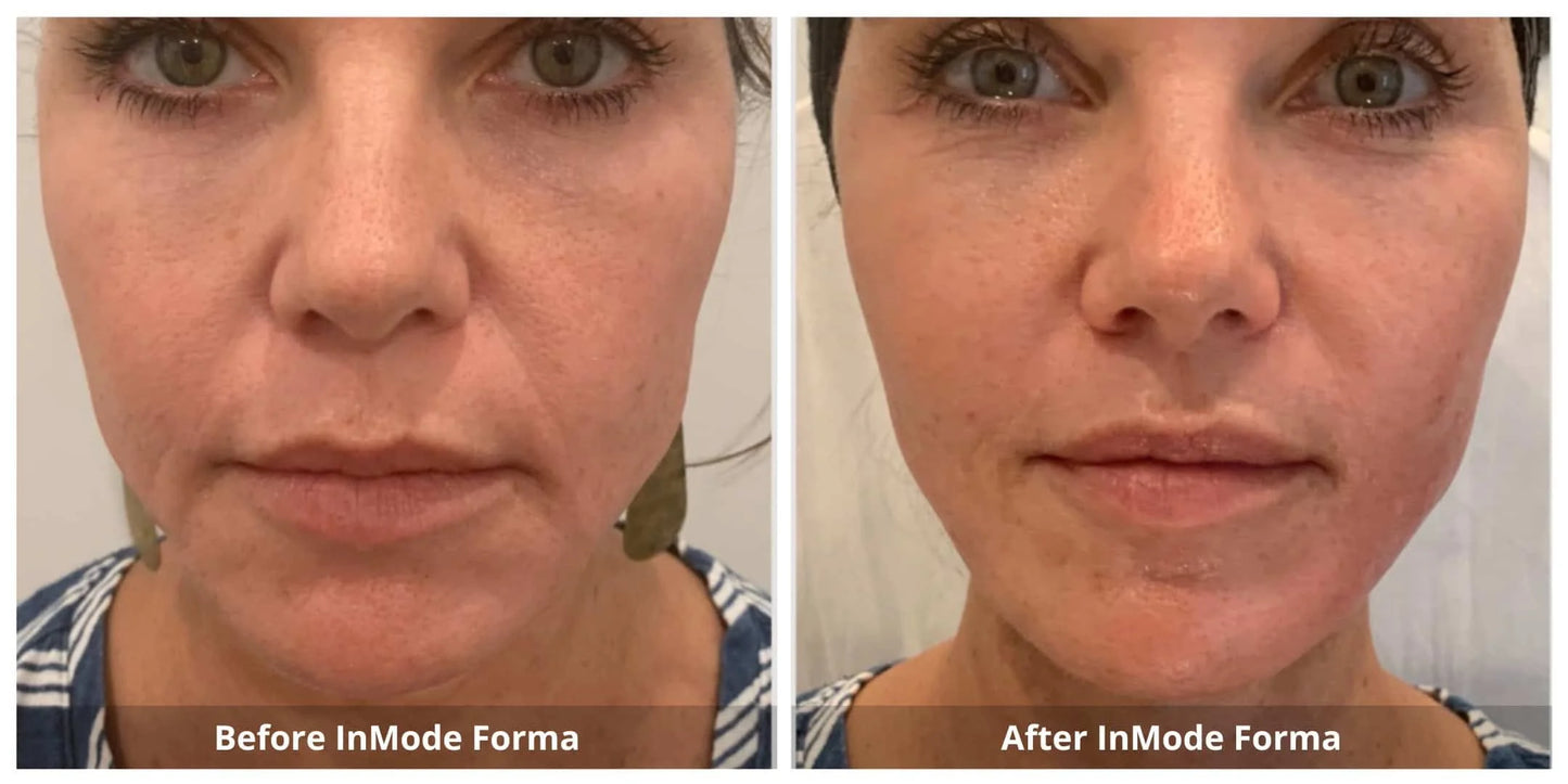 Forma Radiofrequency Skin Tightening