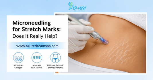 Microneedling for Stretch Marks: Does It Really Help?
