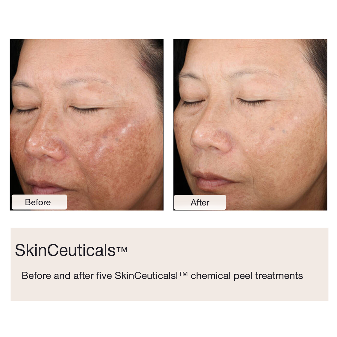 Chemical Peels