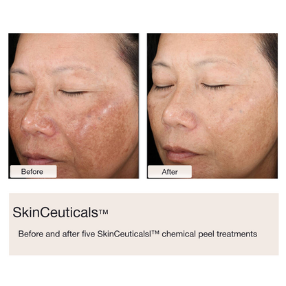 Chemical Peels