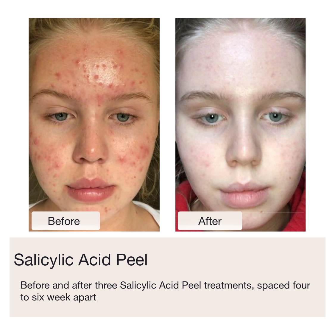 Chemical Peels