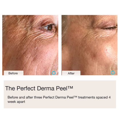 Chemical Peels