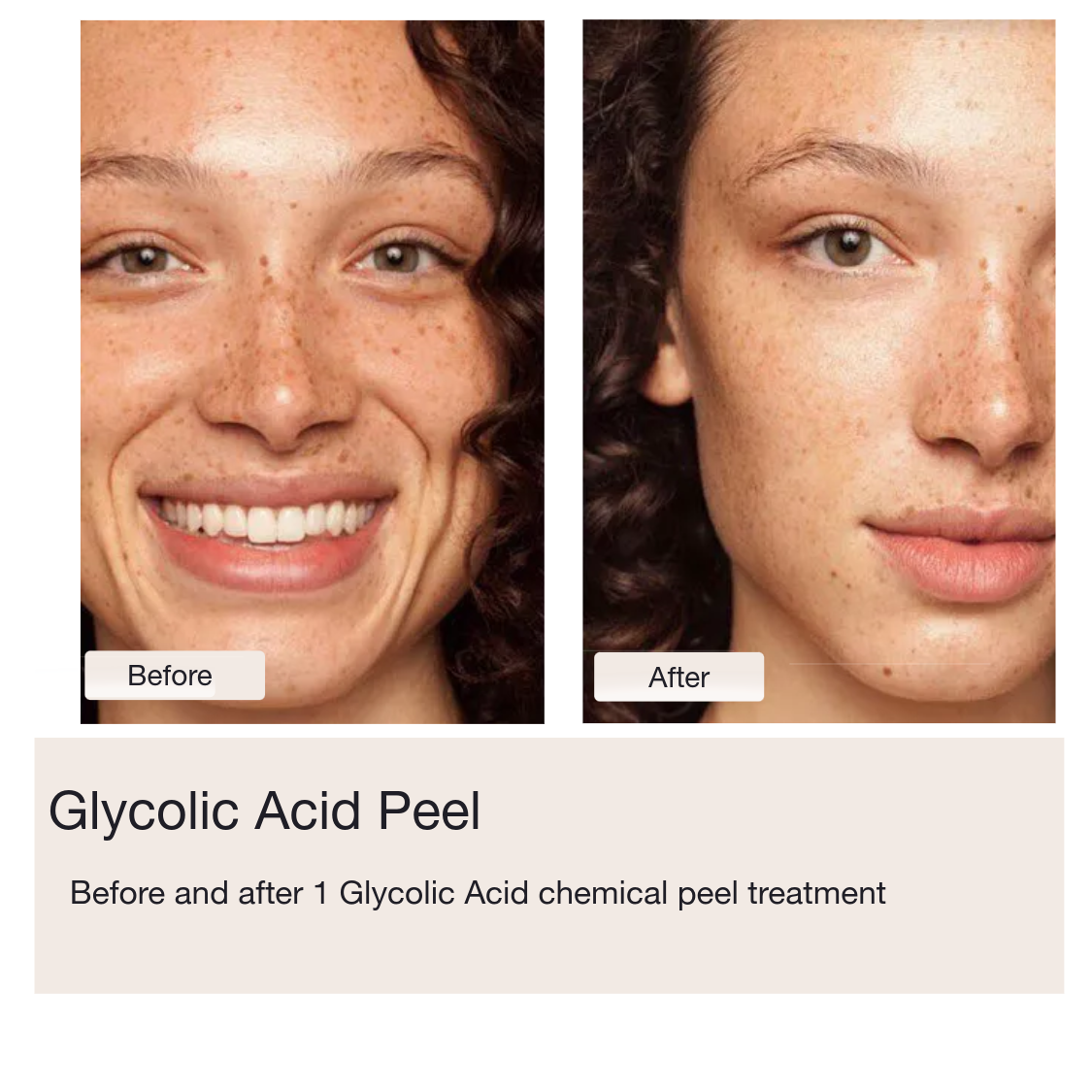 Chemical Peels