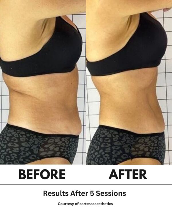 PHYSIQ Body Contouring – Pkg 5 - Image 3