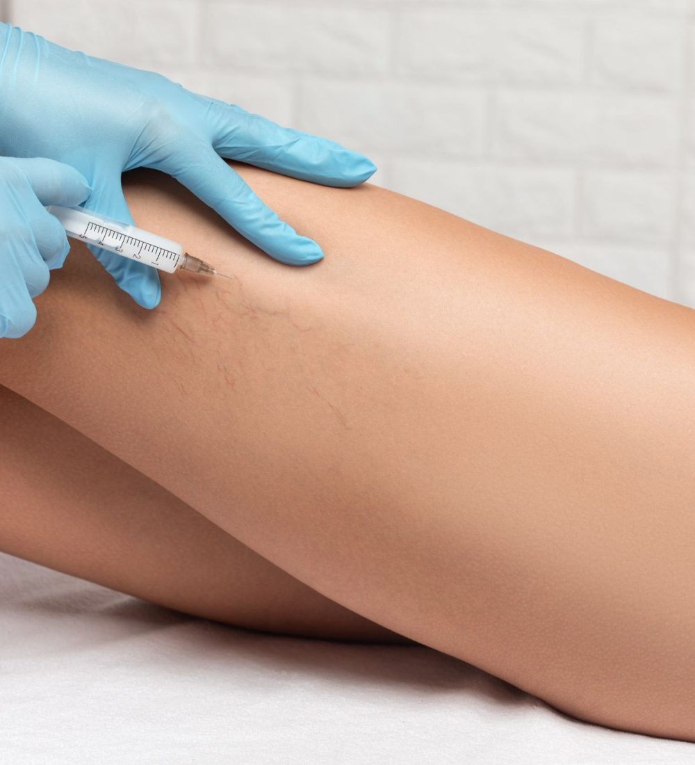 sclerotherapy picture at Azure Dream Medspa for the Injectable Service Page